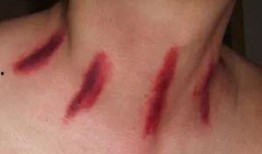 扭痧视频,轻松掌握居家养生新技能