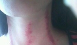 扭痧视频,轻松掌握居家养生新技能